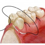 De ce igienizarea profesională a dinților la dentist