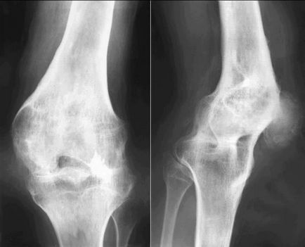 inlocuire a genunchiului, prețul de chirurgie și reabilitare