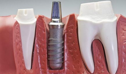 specii Implanturi dentare, ceea ce este mai bine, multe sunt