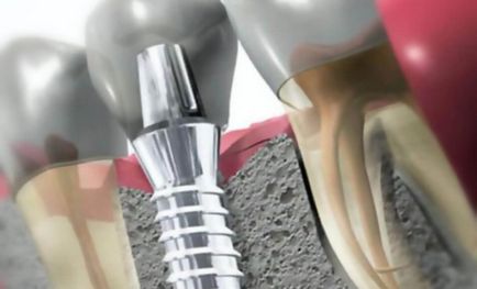 specii Implanturi dentare, ceea ce este mai bine, multe sunt