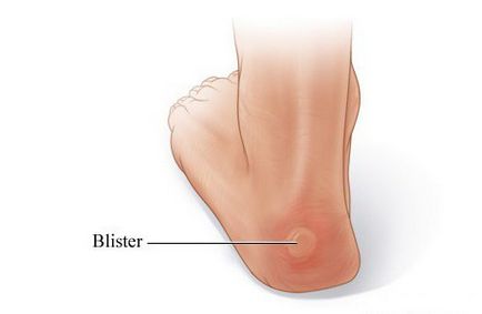 Blister - ceea ce este producția de beneficii și ambalaje tip blister