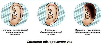 Ce se poate face în cazul în ureche degerături - ce și cum să trateze degerături