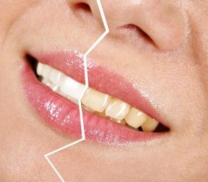 Ce se poate face în cazul în care dinții galbeni cum să eliminați placa