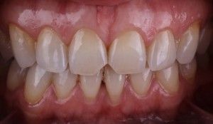 Ce se poate face în cazul în care dinții galbeni cum să eliminați placa