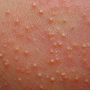 Înflorire sugari cauze de acnee la nou-nascuti, tratamentul erupției hormonale