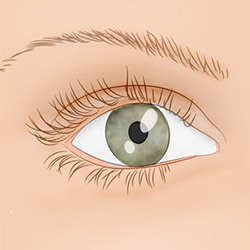 Spasmele ochi (blefarospasm) cauze si tratament
