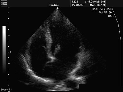 coardă suplimentară a ventriculului stâng (în inima unui copil)