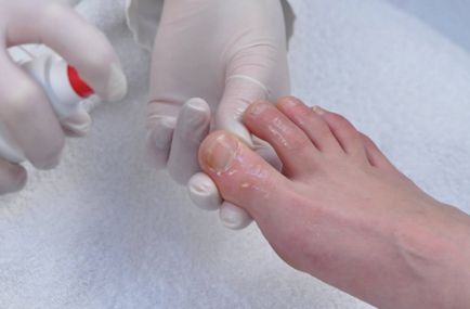 Tratamentul eficient al unghiilor fungice a degetului mare și mâinile