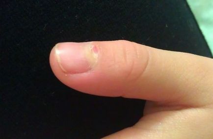 Tratamentul eficient al unghiilor fungice a degetului mare și mâinile