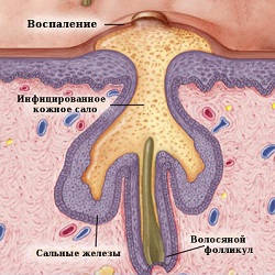 Herpes pe ochi cauze, simptome si metode de a trata boala