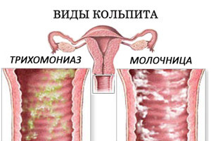 Lista bolilor ginecologice dintre cele mai frecvente