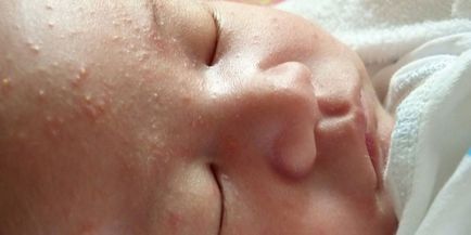 erupții cutanate Hormonal la sugari - atunci când trece și arată ca pustulozå neonatală, fotografii