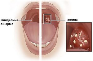 Infectarea a nasului și gâtului, ABC sănătate