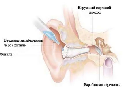 Ce antibiotice sunt necesare pentru copiii cu cele mai bune medicamente de otită sunt luate