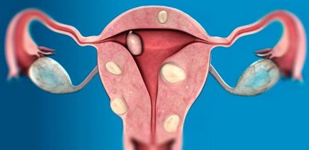 Ce hormoni trebuie să bea cu fibrom uterin si de ce