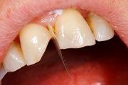 Ce dinți mai bine inserați tipuri de proteze și implanturi