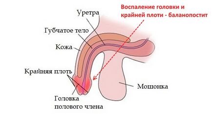 Cum de a trata balanoposthitis la domiciliu