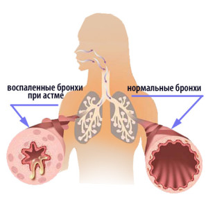Cum de a trata astmul bronșic, să nu dăuneze