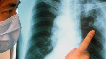 Cum de a trata tuberculoza pulmonară în căile de atac acasă populare, medicina, rețete adulți