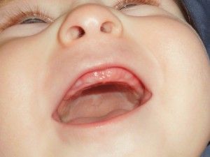 Cum de a urca colții copilului, simptomele primilor dinți