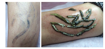 Care este numele pentru o crema de eliminare tatuaj (numit) Care este numele pentru o crema de eliminare tatuaj