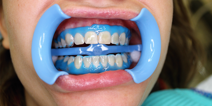 Ceea ce pentru albirea dinților cele mai eficiente și sigure de albire la domiciliu