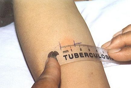 Cum de a identifica tuberculoza