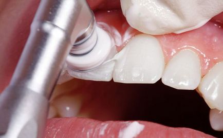 Cum de a albi dintii in metode de revizuire dentare