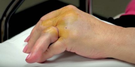 Cum de a sparge un deget fără durere și cauzele - degete și degetele de la picioare