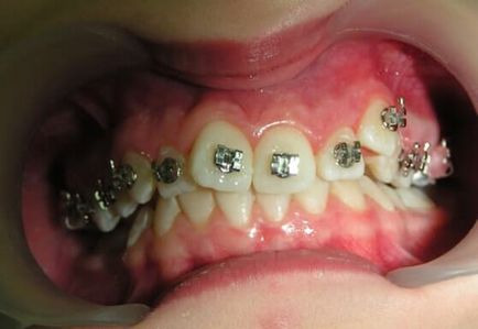 Cum să eliminați suporturile de pe dinti, deoarece este în valoare de ea să ia acolade rănit