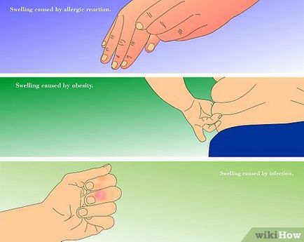 Cum de a elimina umflarea de degete