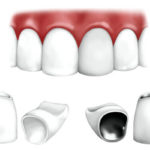 Cum se introduce un dinți de preț, tipuri de dinți falși, care este mai bine, costul normelor de îngrijire