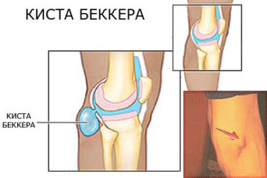 chist Bekker spatele simptomelor genunchi, cum să trateze
