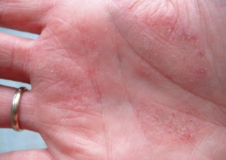 Dermatita de tratament la mâinile