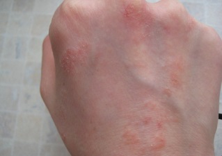 Dermatita de tratament la mâinile
