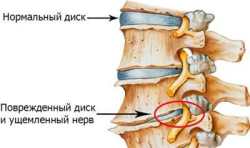 Tratamentul operatiei de hernie spinal fără metode de bază