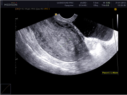 În ce zi a ciclului de a face cu ultrasunete a uterului