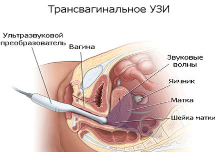 În ce zi a ciclului de a face cu ultrasunete a uterului