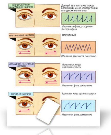 ochi nistagmus, care sunt simptomele, cauzele si tratamentul bolii
