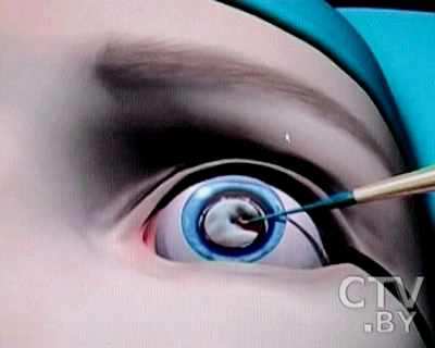 Noi moduri de a trata cataracta mod de a trata cataracta restaurarea vederii
