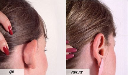 Proeminente urechi pentru a scăpa de urechi droopy