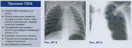 Patologia vederi pulmonare cu raze X, principiile identifica