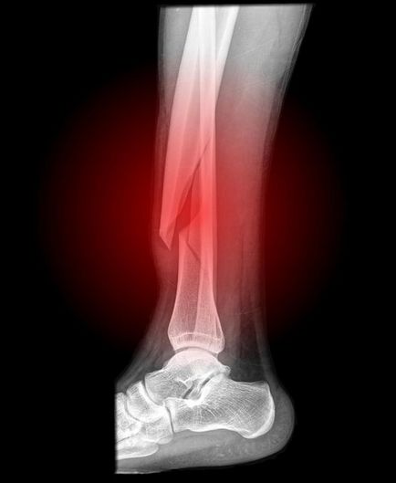 Simptomele picior rupt, semne și tratament