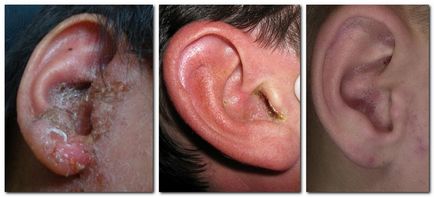 Aceasta provoacă mâncărime severă în ureche, tratamentul metodelor tradiționale cu ajutorul unor unguente si picaturi