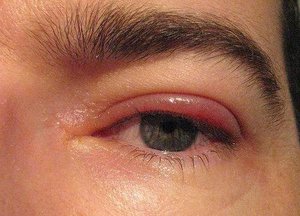 Utilizarea de ochi unguent tetraciclină