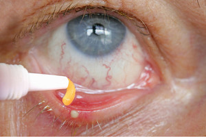 Utilizarea de ochi unguent tetraciclină