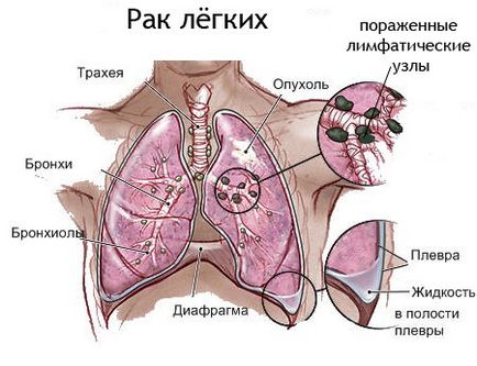 Simptomele cancerului pulmonar, principalele metode de diagnostic, tratament, prevenire, prognostic