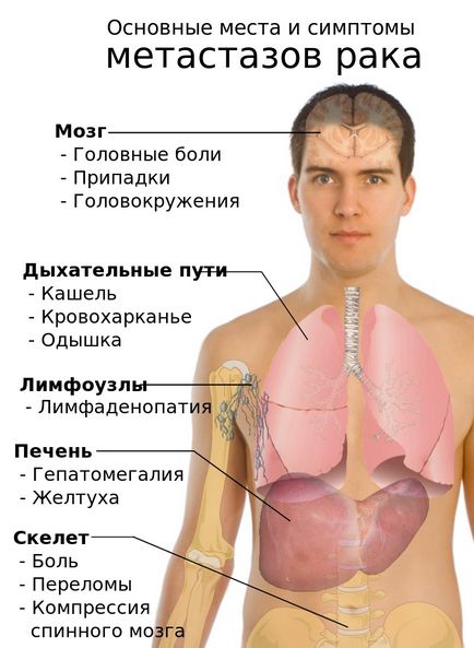 Simptomele cancerului pulmonar, principalele metode de diagnostic, tratament, prevenire, prognostic