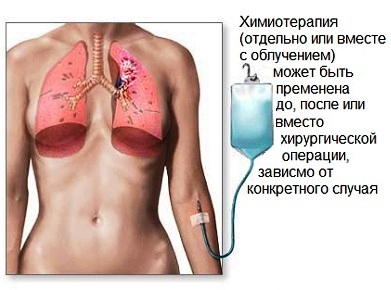Simptomele cancerului pulmonar, principalele metode de diagnostic, tratament, prevenire, prognostic