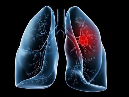 Simptomele cancerului pulmonar, principalele metode de diagnostic, tratament, prevenire, prognostic